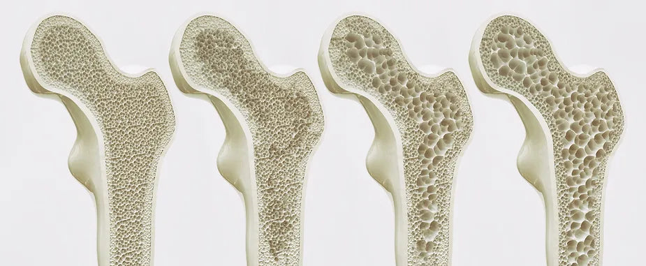 Good Bone Health During Prostate Cancer Treatment