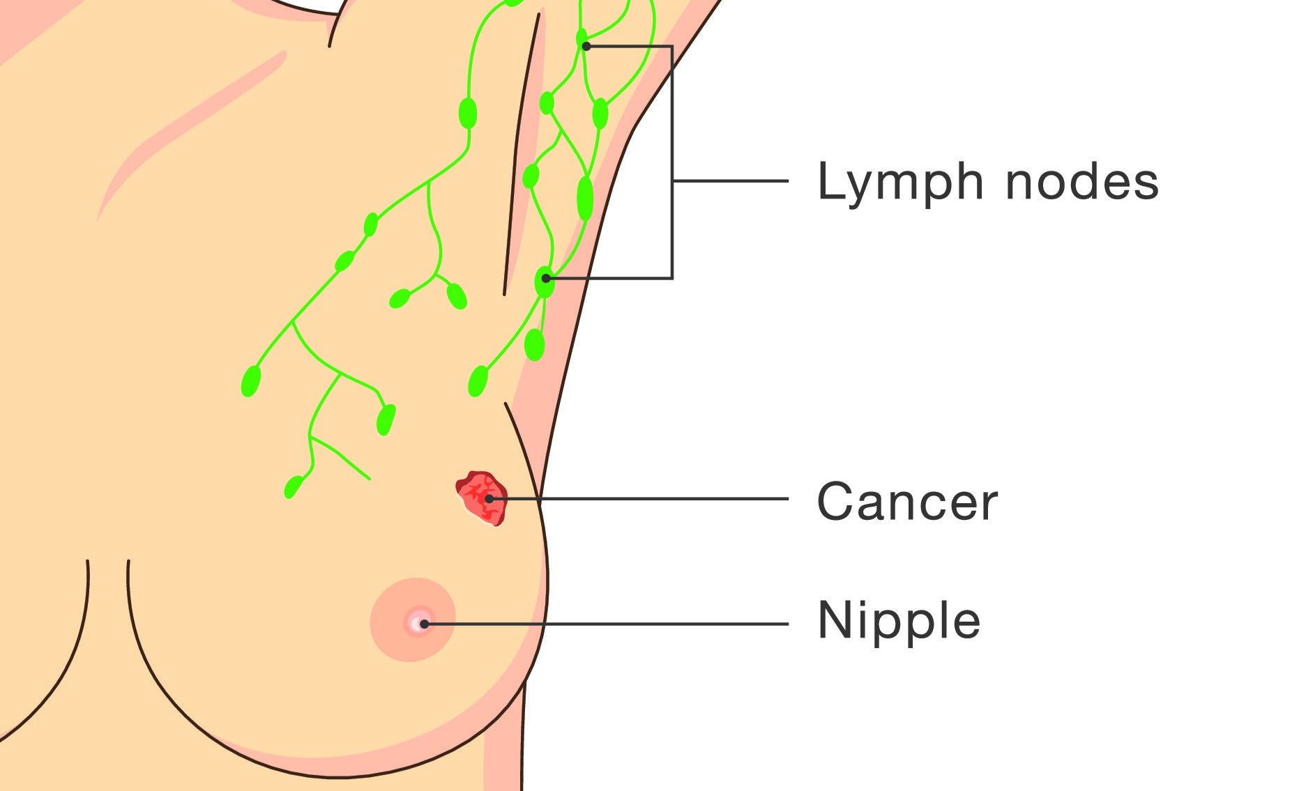 Lymphedema and Breast Cancer