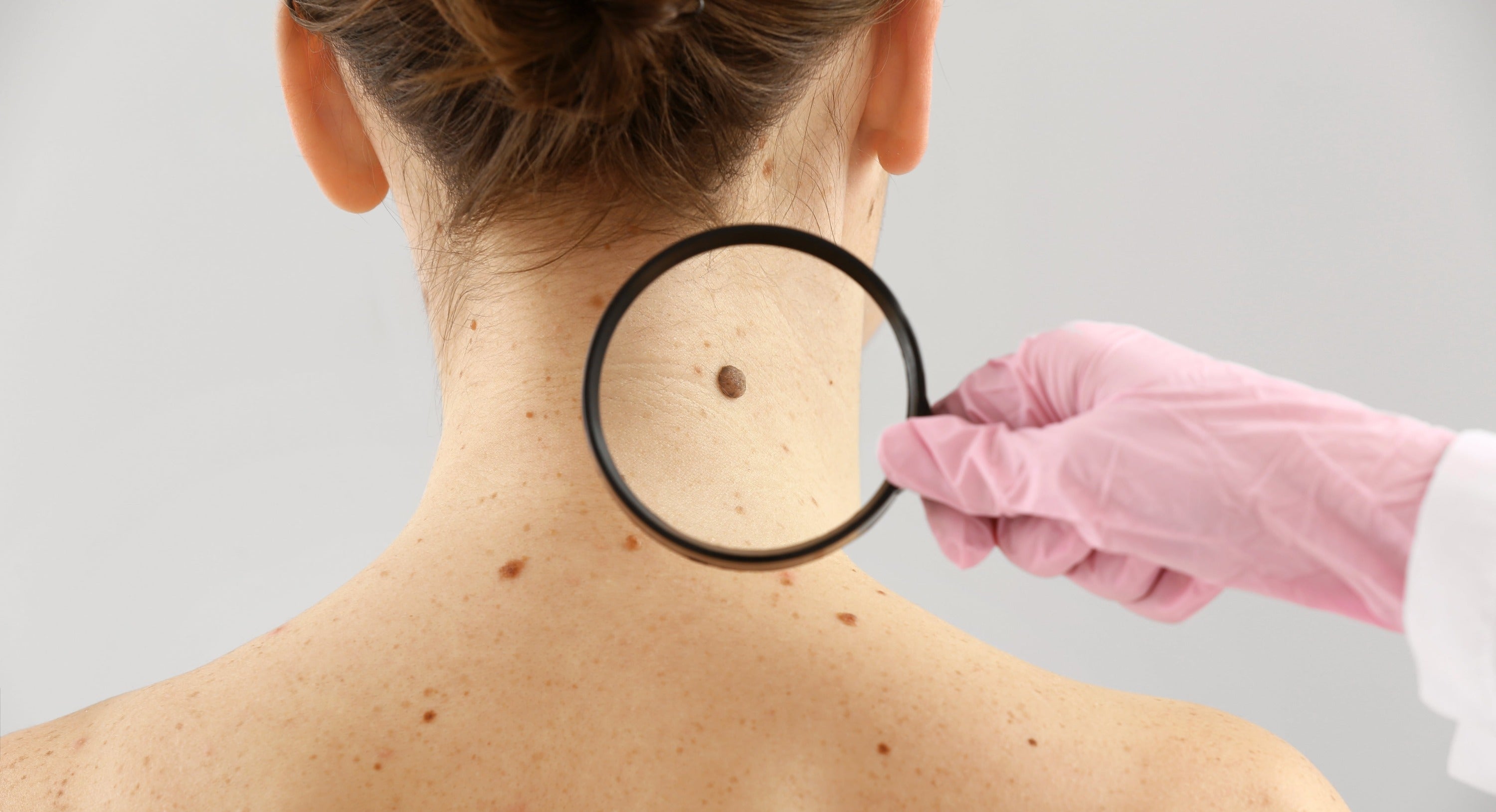 Modifiable Risk Factors for Skin Cancers