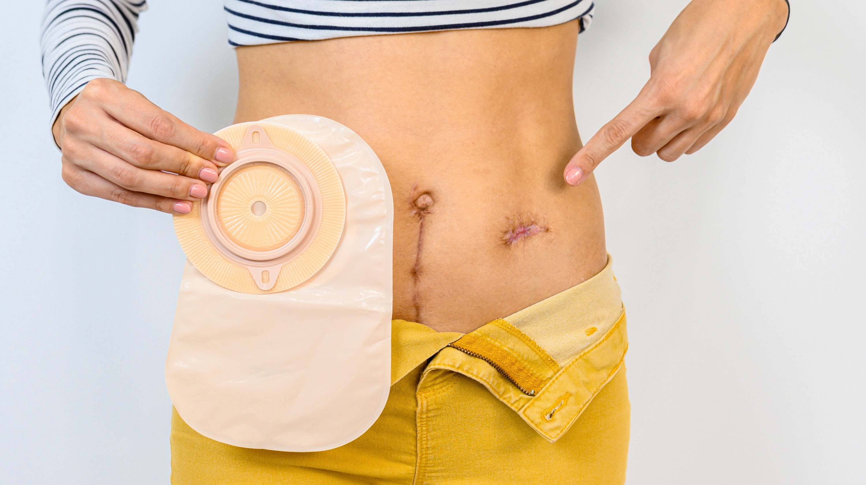Nutrition While Living With an Ostomy Bag
