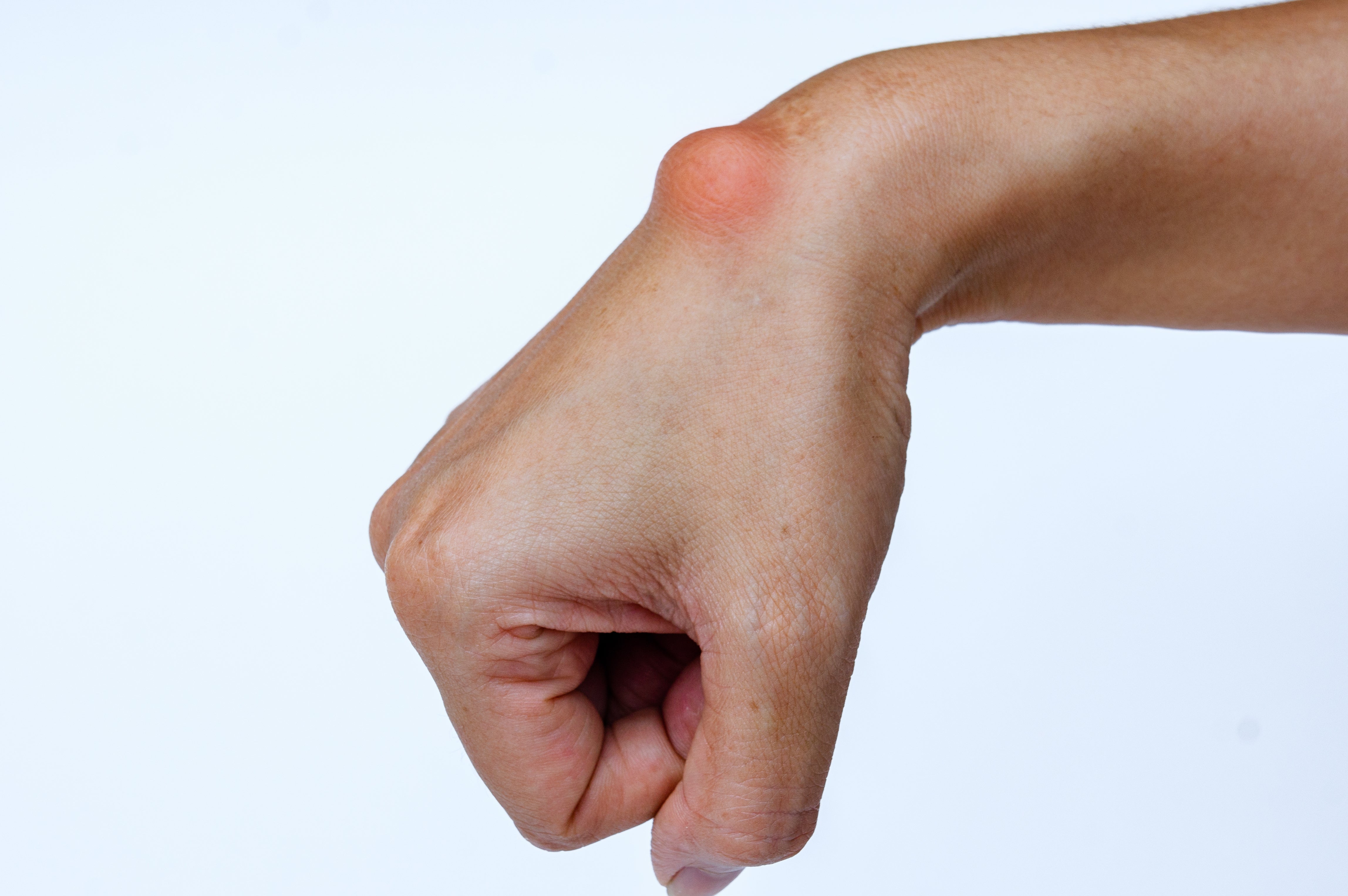 All About Lumps & Bumps
